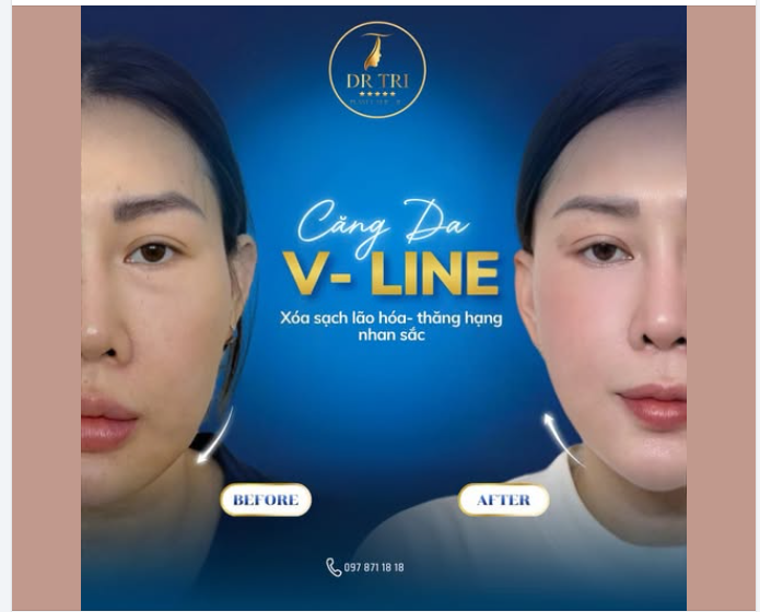 CĂNG DA V-LINE – XÓA SẠCH LÃO HÓA, THĂNG HẠNG NHAN SẮC