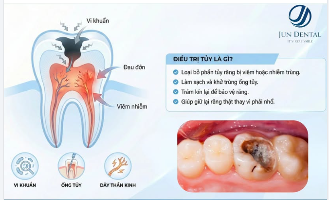 ĐIỀU TRỊ TỦY RĂNG – GIỮ LẠI RĂNG THẬT, CHẤM DỨT CƠN ĐAU