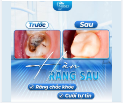 HÀN RĂNG SÂU - RĂNG CHẮC KHỎE, CƯỜI TỰ TIN