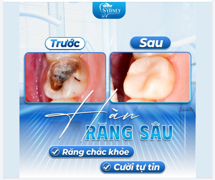 HÀN RĂNG SÂU - RĂNG CHẮC KHỎE, CƯỜI TỰ TIN