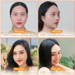 Thất bại sau 2 lần sửa mũi trước đó, H.M. tự ti dù mũi cao nhưng to, thô và l.ệch khá nhiều.