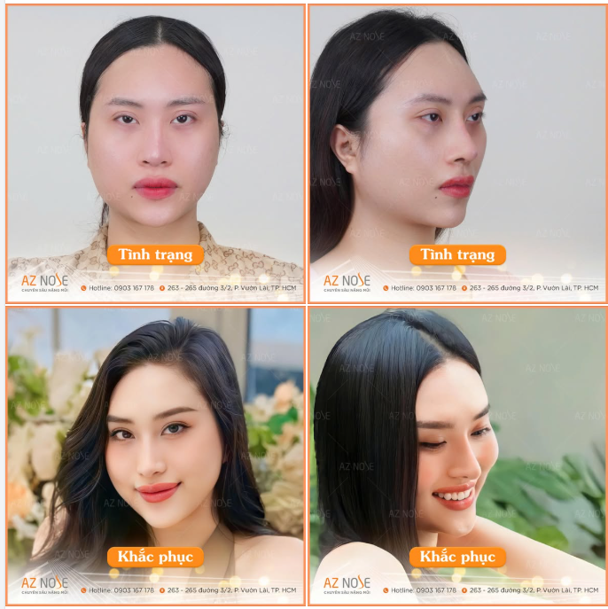 Thất bại sau 2 lần sửa mũi trước đó, H.M. tự ti dù mũi cao nhưng to, thô và l.ệch khá nhiều.