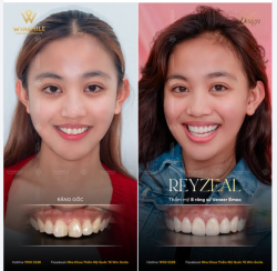 Sống tại Úc và mang trong mình dòng máu Philippines, Reyzeal là một cô gái hiện đại, đã được tiếp cận với những chuẩn mực y khoa tiên tiến nhất ở nước ngoài.