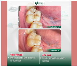 HÀN RĂNG SÂU TẠI NHA KHOA GIA ĐÌNH - THẨM MỸ, AN TOÀN, CHẤT LƯỢNG