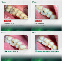 Giải quyết dứt điểm sâu tái phát chỉ sau 1 lần hẹn
