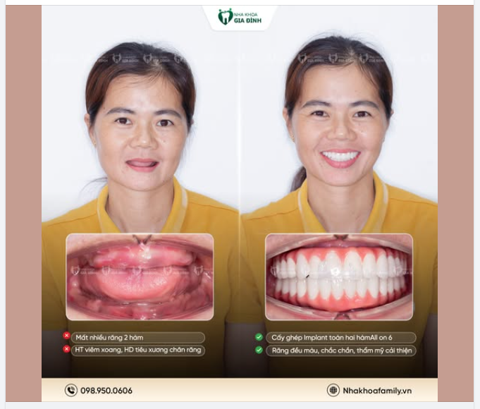 36 tuổi - Quá trẻ để chấp nhận mất nhiều răng 2 hàm