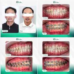 NIỀNG RĂNG - THAY ĐỔI TỪNG CHÚT MỘT ĐỂ TRỞ THÀNH PHIÊN BẢN HOÀN THIỆN HƠN