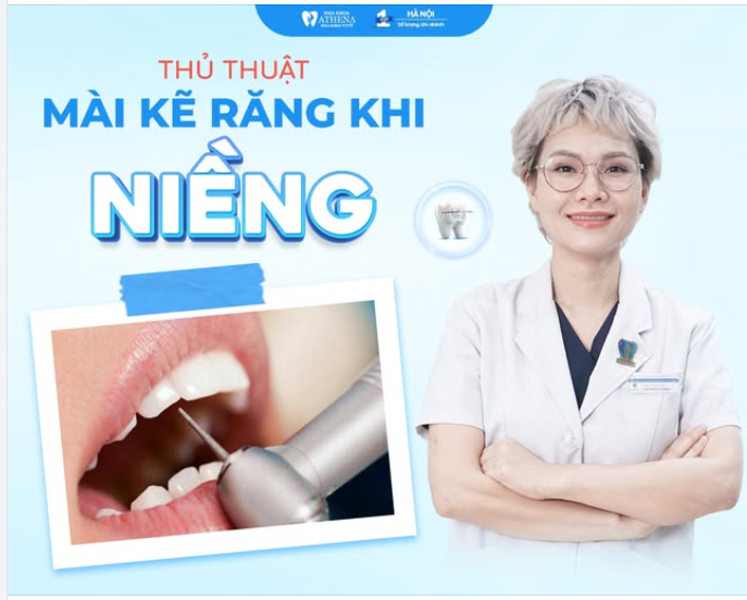 Mài kẽ răng khi niềng – sự thật bạn nên biết