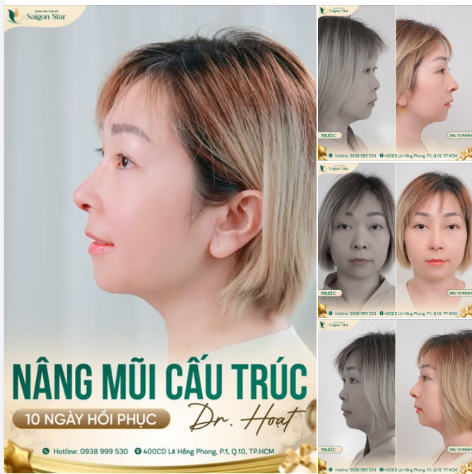 NÀNG NÀO ĐANG CÒN TỰ TI VÌ CHIẾC MŨI THẤP TẸT CỦA MÌNH?? INBOX NGAY CHO BÁC SĨ HOẠT