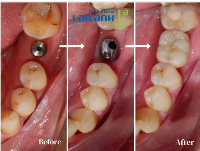 Mất răng số 6 – chuyện rất hay gặp