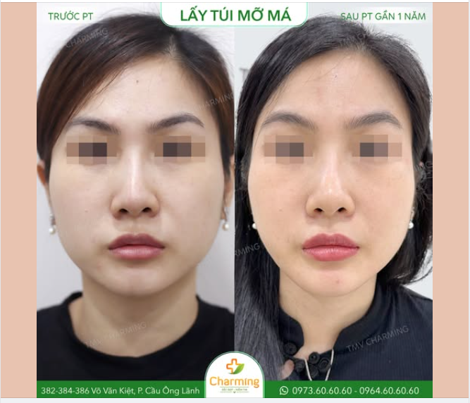 Dù có giảm cân hay tập luyện thế nào thì vùng mỡ này cũng rất khó mất đi.