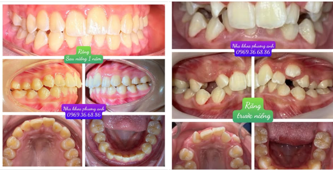 Kế hoạch điều trị chỉnh nha