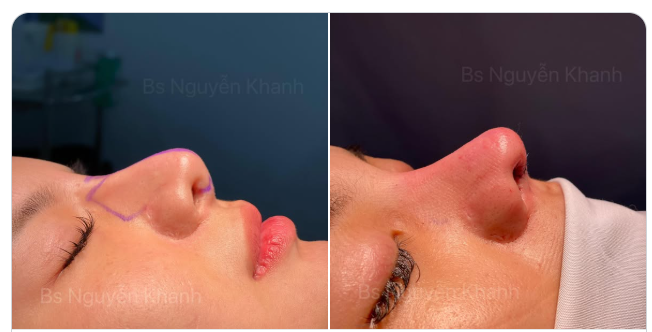 Một buổi chiều mưa, sau lễ hơi "cháy lịch" 1 xíu. Thoai thì ngắm đỡ mũi xinh rồi mình qua tuần mình đến tư vấn sau nhe.