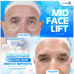 MID FACE LIFT - TRẺ HÓA TẦNG MẶT GIỮA