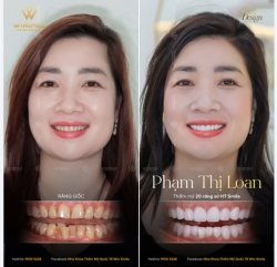 Sở hữu những đường nét gương mặt hài hòa và cuốn hút, nhưng nụ cười của chị Loan lại phần nào kém trọn vẹn bởi những khuyết điểm ở hàm răng: hàm dưới khấp khểnh