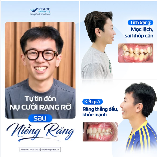 TỪ RĂNG KHẤP KHỂNH ĐẾN NỤ CƯỜI TỰ TIN