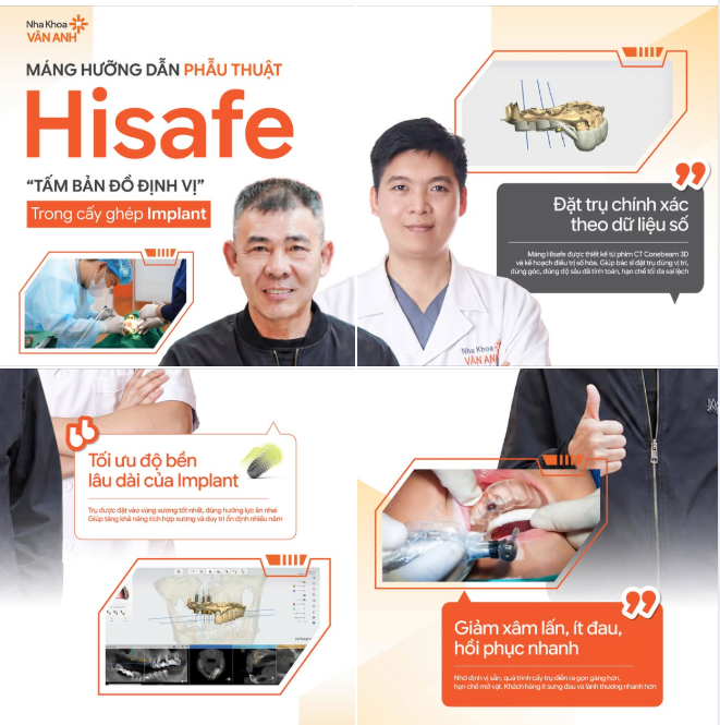 ĐÁNH TAN NỖI SỢ VÔ HÌNH KHI TRỒNG IMPLANT - CÔNG NGHỆ CẤY GHÉP ĐỊNH VỊ MỚI