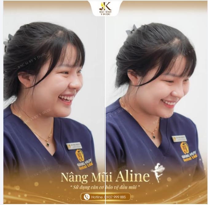 Sau nâng mũi Aline:  Ảnh nào cũng đăng được, góc nào cũng tự tin