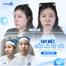 TẠM BIỆT ĐẦU MŨI CỦ TỎI
