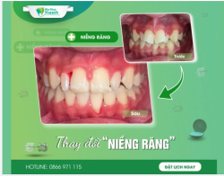 Niềng răng sớm – thay đổi rõ ràng từng ngày