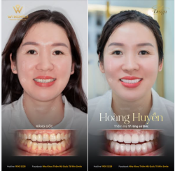 Sự thay đổi sau cùng không nằm ở việc nụ cười trở nên nổi bật hơn bao nhiêu, mà ở cảm giác tự nhiên và ổn định khi chị Huyền mỉm cười