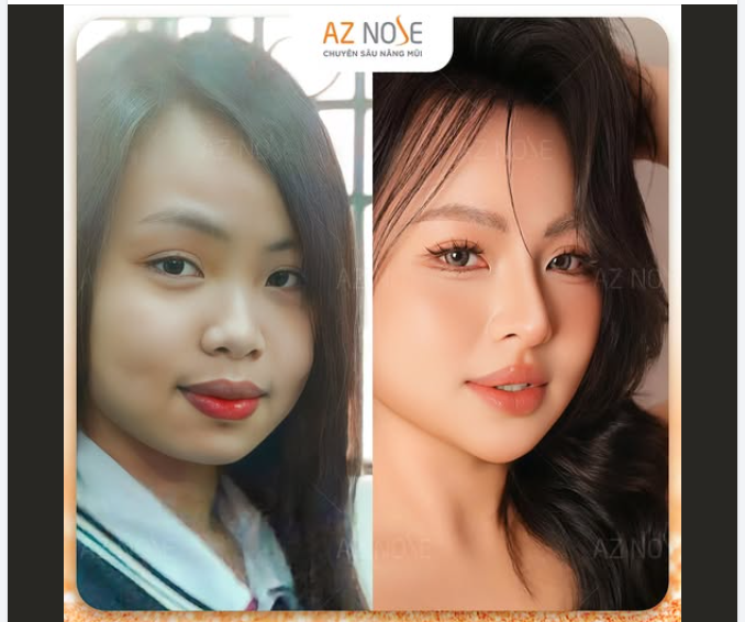 Khác biệt sau 5 năm nâng mũi cấu trúc ở AZNOSE, thực hiện bởi bác sĩ CKI. Nguyễn Hoàng Nam