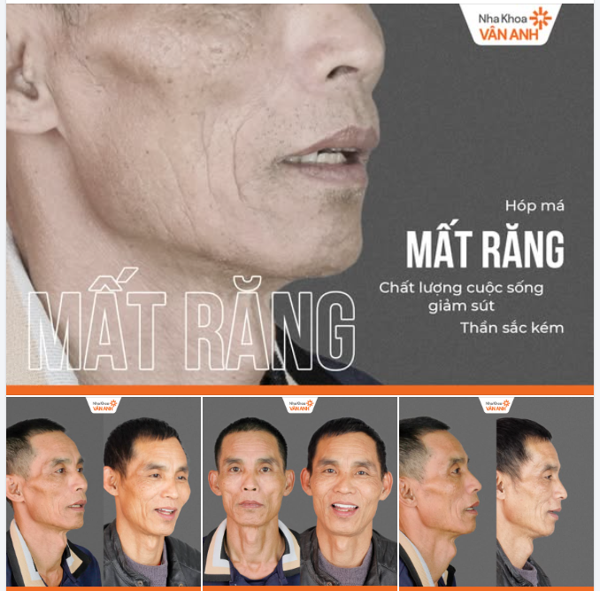 MẤT RĂNG: KHÔNG CHỈ LÀ CHUYỆN ĂN NHAI, ĐÓ LÀ SỰ "SỤP ĐỔ" CỦA CƠ MẶT