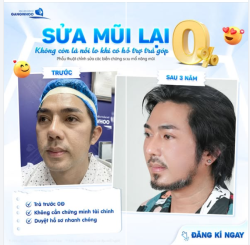 SỬA MŨI LẠI KHÔNG CÒN LÀ NỖI LO