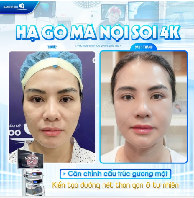 CÂN CHỈNH CẤU TRÚC - TRẺ HÓA GƯƠNG MẶT