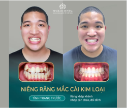 MỪNG NGÀY THÁO NIỀNG - KHÁCH HÀNG: NGUYỄN MINH THẮNG