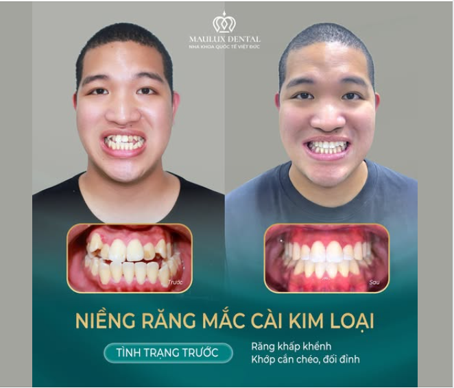 MỪNG NGÀY THÁO NIỀNG - KHÁCH HÀNG: NGUYỄN MINH THẮNG