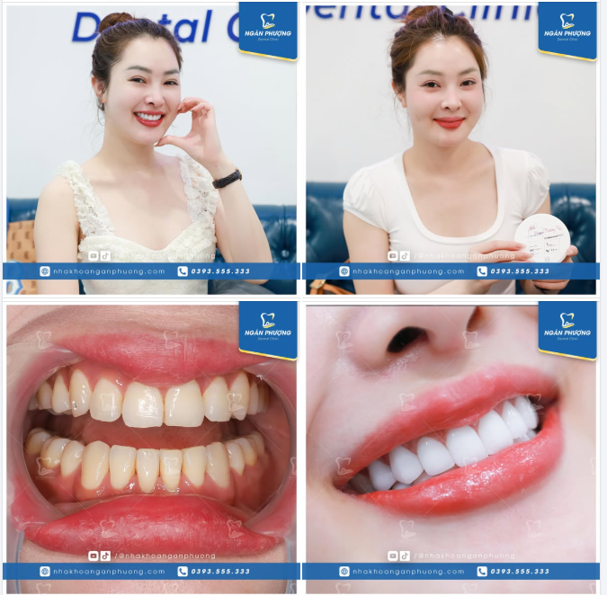 Rạng rỡ nụ cười cá nhân hóa với sứ Nacera từ CHLB Đức