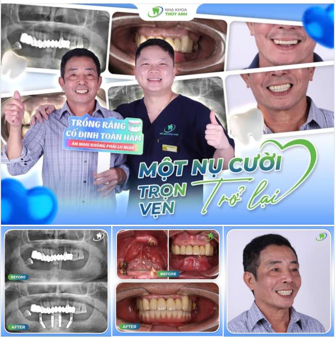 MỘT NỤ CƯỜI TRỌN VẸN TRỞ LẠI