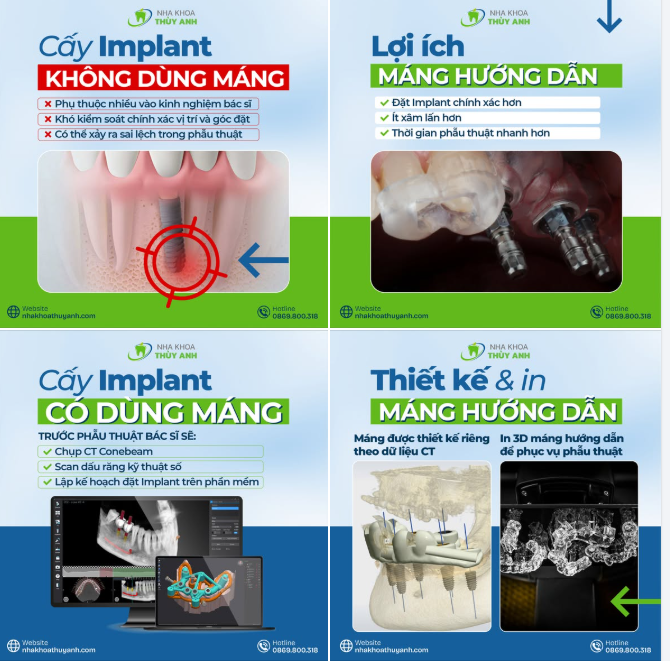 VÌ SAO CẤY GHÉP IMPLANT NÊN SỬ DỤNG MÁNG HƯỚNG DẪN PHẪU THUẬT?