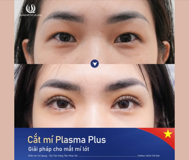 Nhiều người vẫn còn hiểu lầm về cắt mí: Sợ đau, sợ “giả trân” hay nghĩ làm xong cũng không khác nhiều,...