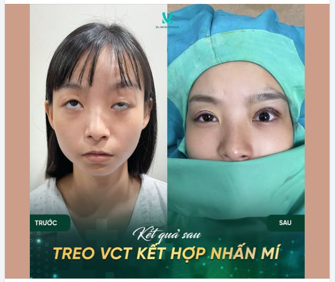 TỪ ĐÔI MẮT MỆT MỎI → ÁNH NHÌN RÕ NÉT VÀ CÓ HỒN HƠN