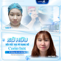 TẠO HÌNH MẮT HAI MÍ - HỒI PHỤC NHANH CHÓNG