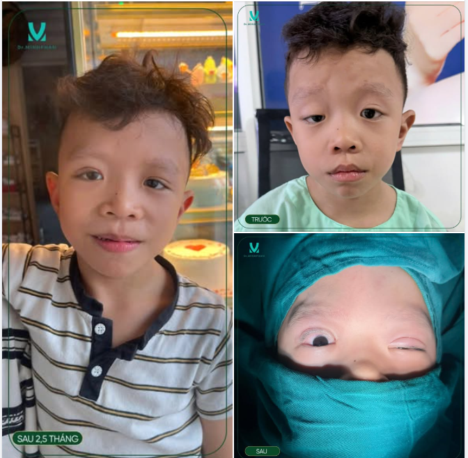 Tình trạng trước, bé bị sụp mi mắt phải bẩm sinh, mí che gần hết mắt, khiến ánh nhìn của bé lúc nào cũng mệt mỏi, buồn và thiếu linh hoạt.
