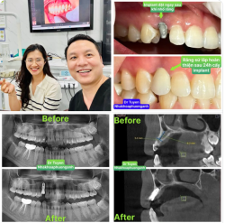 Cô csgt dẫn đoàn xinh đẹp được mẹ chồng đưa tới gặp bác sĩ với tình trạng chiếc răng sữa lung lay do thiếu mầm răng vĩnh viễn.