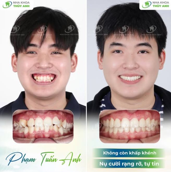 NIỀNG RĂNG SẮP XẾP LẠI RĂNG KHẤP KHỂNH NẶNG, CƯỜI HỞ LỢI