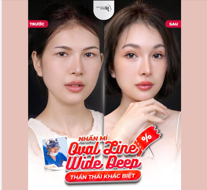 NHẤN MÍ OVAL LINE WIDE DEEP – MẮT SANG CHẢNH, QUYẾN RŨ