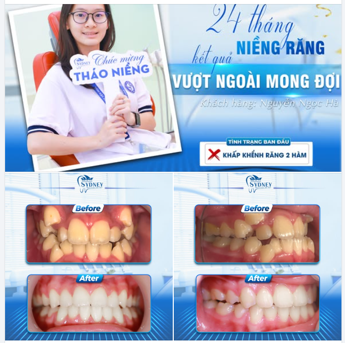 24 THÁNG NIỀNG RĂNG VÀ KẾT QUẢ VƯỢT NGOÀI MONG ĐỢI