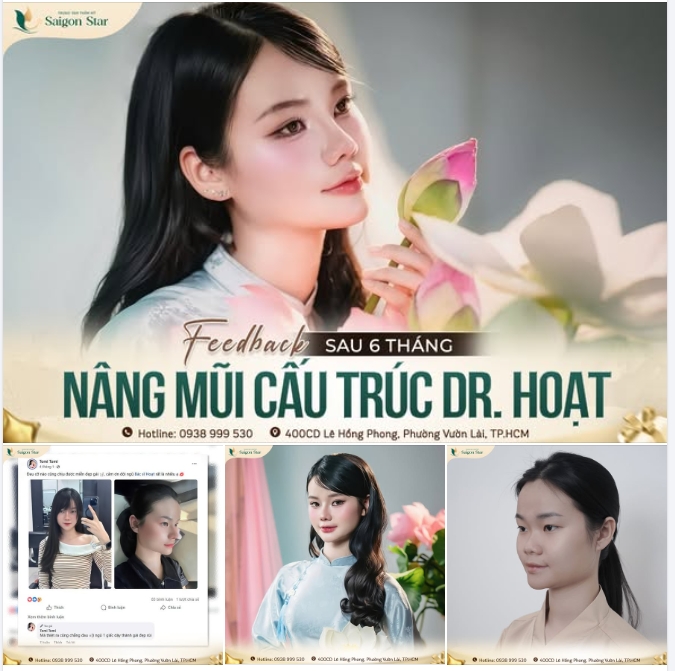NÂNG MŨI CẤU TRÚC SURGIFORM SAU 3 THÁNG