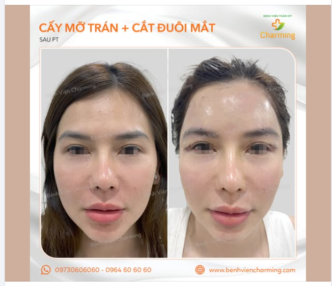 CẢI THIỆN VÙNG TRÁN  ĐUÔI MẮT - GIỮ GÌN NÉT TRẺ TRUNG
