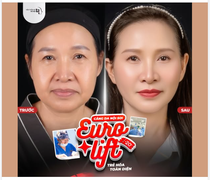CĂNG DA NỘI SOI EURO LIFT - ĐẨY LÙI LÃO HOÁ