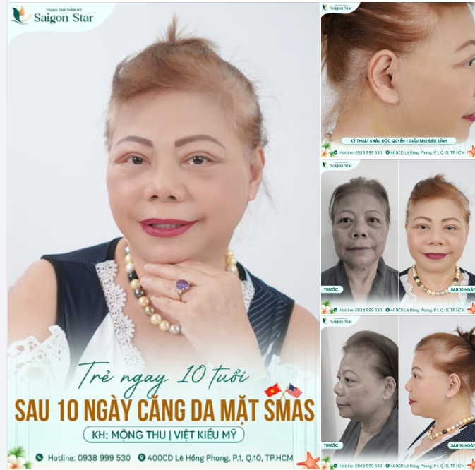 VIỆT KIỀU MỸ “LÃO HÓA NGƯỢC” THÀNH CÔNG SAU 10 NGÀY CĂNG DA MẶT SMAS