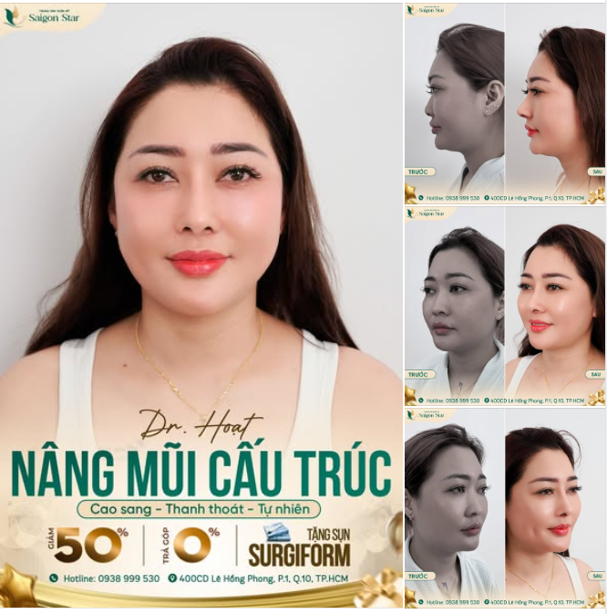 NÂNG MŨI CẤU TRÚC DR. HOẠT - BÍ QUYẾT CHO MŨI ĐẸP BỀN VỮNG