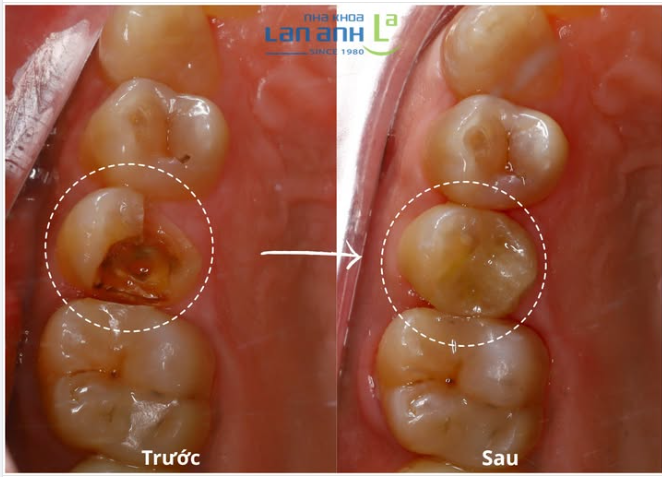 Ăn nhai chắc khỏe, cười xinh mỗi ngày