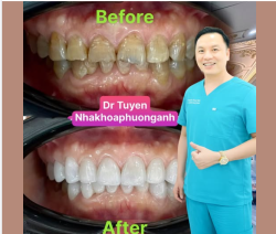 Những Phương Pháp Nha Khoa Thẩm Mỹ Phổ Biến Nhất Hiện Nay
