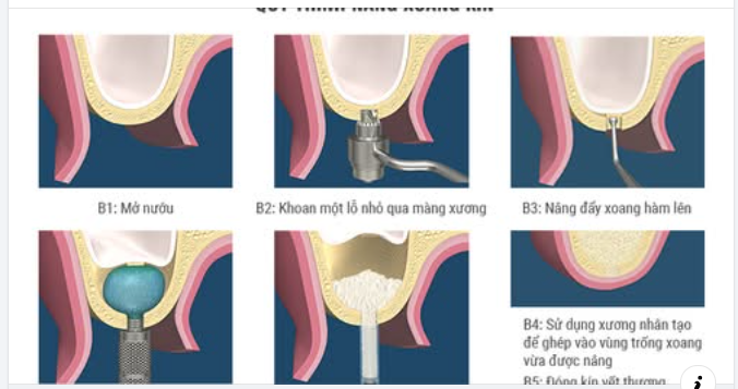 NÂNG XOANG TRONG CẤY GHÉP IMPLANT